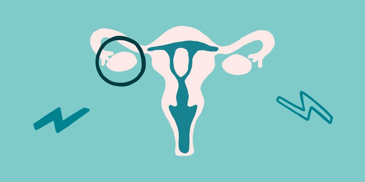 Cancer de l’ovaire : tout savoir