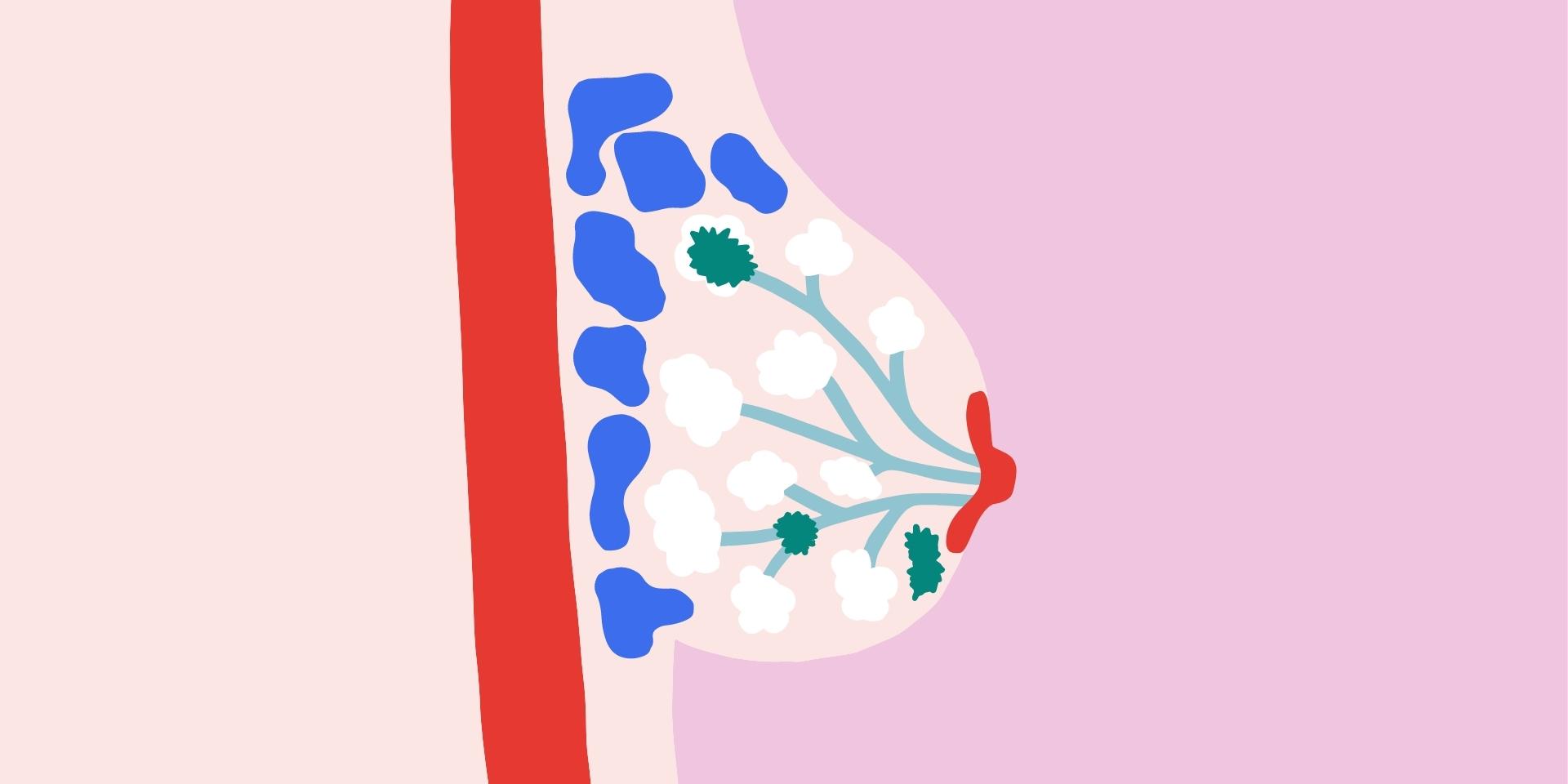 Cancer du sein - Guide complet | Barnabe.io